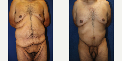 Case 8409 - 45-54 year old man treated with Body Lift