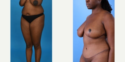 Case 841 - 35-44 year old woman treated with Mommy Makeover, Breast Lift, Breast Reduction, Tummy Tuck, Tumescent Liposuction, Vaser Liposu