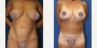 Case 8411 - Woman treated with Body Lift