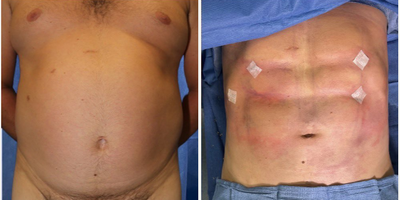 Case 8412 - 35-44 year old Man treated with Body Lift