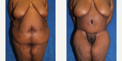 Case 8413 - 35-44 year old woman treated with Body Lift