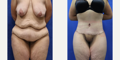 Case 8414 - 25-34 year old woman treated with Body Lift