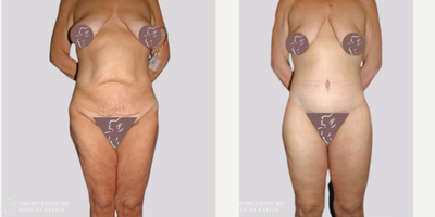 Case 8415 - 45-54 year old woman treated with Body Lift