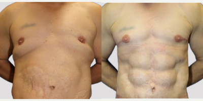Case 8417 - 35-44 year old woman treated with Vaser Liposuction, Body Lift