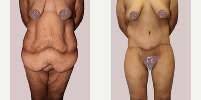 Case 8418 - 35-44 year old woman treated with Body Lift