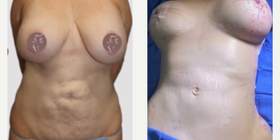 Case 8419 - 35-44 year old woman treated with Breast Augmentation, Breast Lift, Body Lift