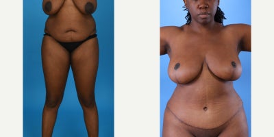 Case 842 - 35-44 year old woman treated with Mommy Makeover, Breast Lift, Breast Reduction, Tummy Tuck, Tumescent Liposuction, Vaser Liposu