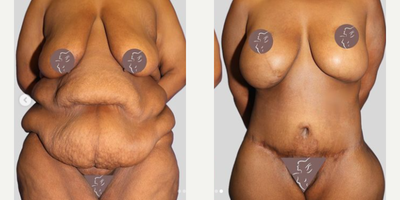 Case 8421 - Body Lift