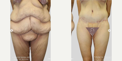 Case 8422 - 35-44 year old woman treated with Body Lift