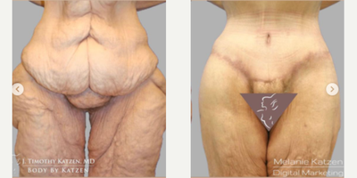 Case 8423 - 45-54 year old woman treated with Body Lift