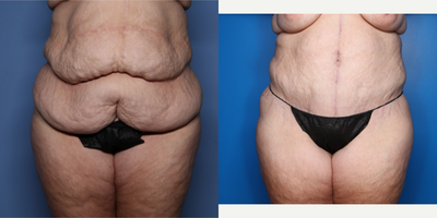 Case 8424 - 35-44 year old woman treated with Body Lift