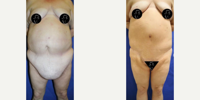 Case 8425 - 45-54 year old woman treated with Body Lift