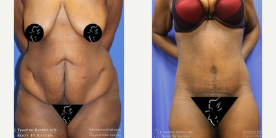 Case 8426 - 25-34 year old woman treated with Body Lift