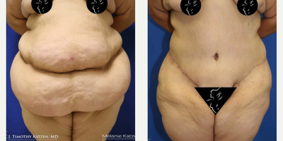 Case 8427 - 35-44 year old woman treated with Body Lift