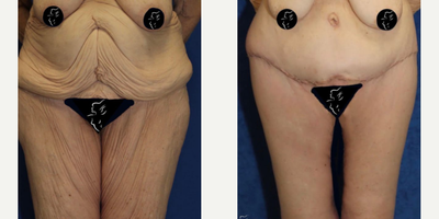 Case 8428 - 65-74 year old woman treated with Body Lift