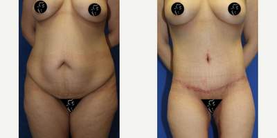 Case 8429 - 25-34 year old woman treated with Body Lift