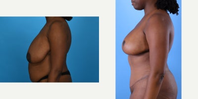 Case 843 - 35-44 year old woman treated with Mommy Makeover, Breast Lift, Breast Reduction, Tummy Tuck, Tumescent Liposuction, Vaser Liposu