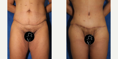 Case 8431 - 18-24 year old woman treated with Body Lift