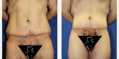 Case 8432 - 25-34 year old woman treated with Body Lift