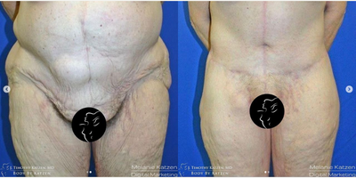 Case 8433 - 45-54 year old woman treated with Body Lift