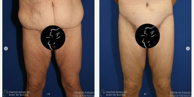 Case 8434 - 35-44 year old woman treated with Body Lift