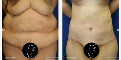 Case 8435 - 25-34 year old woman treated with Body Lift