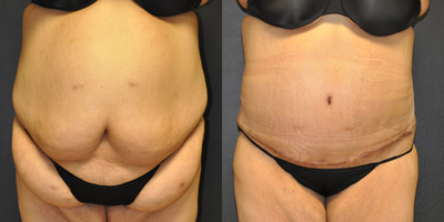 Case 8436 - 34 year old woman treated with Body Lift