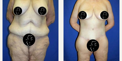 Case 8437 - 55-64 year old woman treated with Body Lift