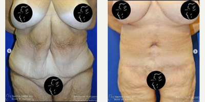 Case 8438 - 55-64 year old woman treated with Body Lift