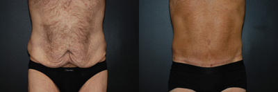 Case 8439 - 44 year old man treated with Body Lift