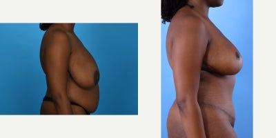 Case 844 - 35-44 year old woman treated with Mommy Makeover, Breast Lift, Breast Reduction, Tummy Tuck, Tumescent Liposuction, Vaser Liposu