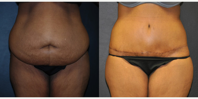 Case 8440 - Woman treated with Body Lift