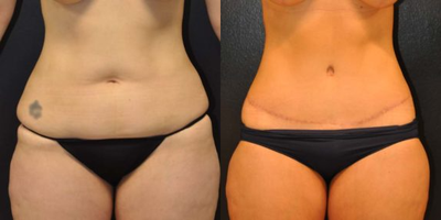 Case 8442 - 34 year old woman treated with Body Lift