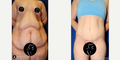 Case 8443 - 18-24 year old woman treated with Body Lift