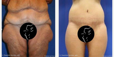 Case 8444 - 25-34 year old woman treated with Body Lift