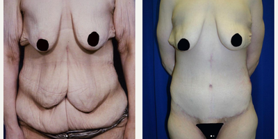 Case 8445 - 45-54 year old woman treated with Body Lift