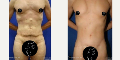 Case 8446 - 35-44 year old woman treated with Body Lift