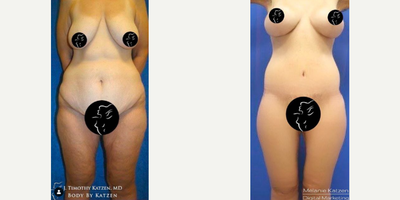 Case 8447 - Body Lift