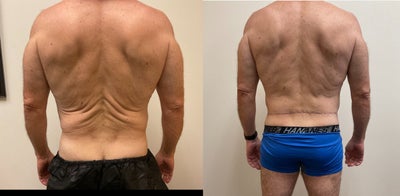 Case 8448 - 45-54 year old man treated with Body Lift