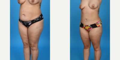 Case 8449 - 35-44 year old woman treated with Body Lift, Diastasis Recti Repair, Liposuction, Mommy Makeover, Panniculectomy, Tumescent Lipo