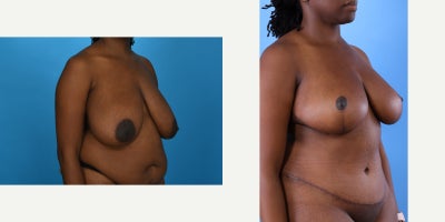 Case 845 - 35-44 year old woman treated with Mommy Makeover, Breast Lift, Breast Reduction, Tummy Tuck, Tumescent Liposuction, Vaser Liposu