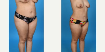 Case 8450 - 35-44 year old woman treated with Body Lift, Diastasis Recti Repair, Liposuction, Mommy Makeover, Panniculectomy, Tumescent Lipo