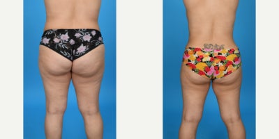 Case 8451 - 35-44 year old woman treated with Body Lift, Diastasis Recti Repair, Liposuction, Mommy Makeover, Panniculectomy, Tumescent Lipo