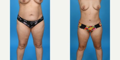 Case 8452 - 35-44 year old woman treated with Body Lift, Diastasis Recti Repair, Liposuction, Mommy Makeover, Panniculectomy, Tumescent Lipo