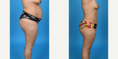 Case 8453 - 35-44 year old woman treated with Body Lift, Diastasis Recti Repair, Liposuction, Mommy Makeover, Panniculectomy, Tumescent Lipo