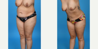 Case 8455 - 35-44 year old woman treated with Body Lift, Diastasis Recti Repair, Liposuction, Mommy Makeover, Panniculectomy, Tumescent Lipo
