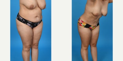 Case 8456 - 35-44 year old woman treated with Body Lift, Diastasis Recti Repair, Liposuction, Mommy Makeover, Panniculectomy, Tumescent Lipo