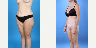 Case 8459 - 35-44 year old woman treated with Abdominal Etching, Tummy Tuck, Liposculpture, Mommy Makeover, Panniculectomy, Tumescent Liposu