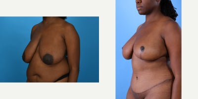 Case 846 - 35-44 year old woman treated with Mommy Makeover, Breast Lift, Breast Reduction, Tummy Tuck, Tumescent Liposuction, Vaser Liposu