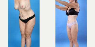 Case 8460 - 35-44 year old woman treated with Abdominal Etching, Tummy Tuck, Liposculpture, Mommy Makeover, Panniculectomy, Tumescent Liposu